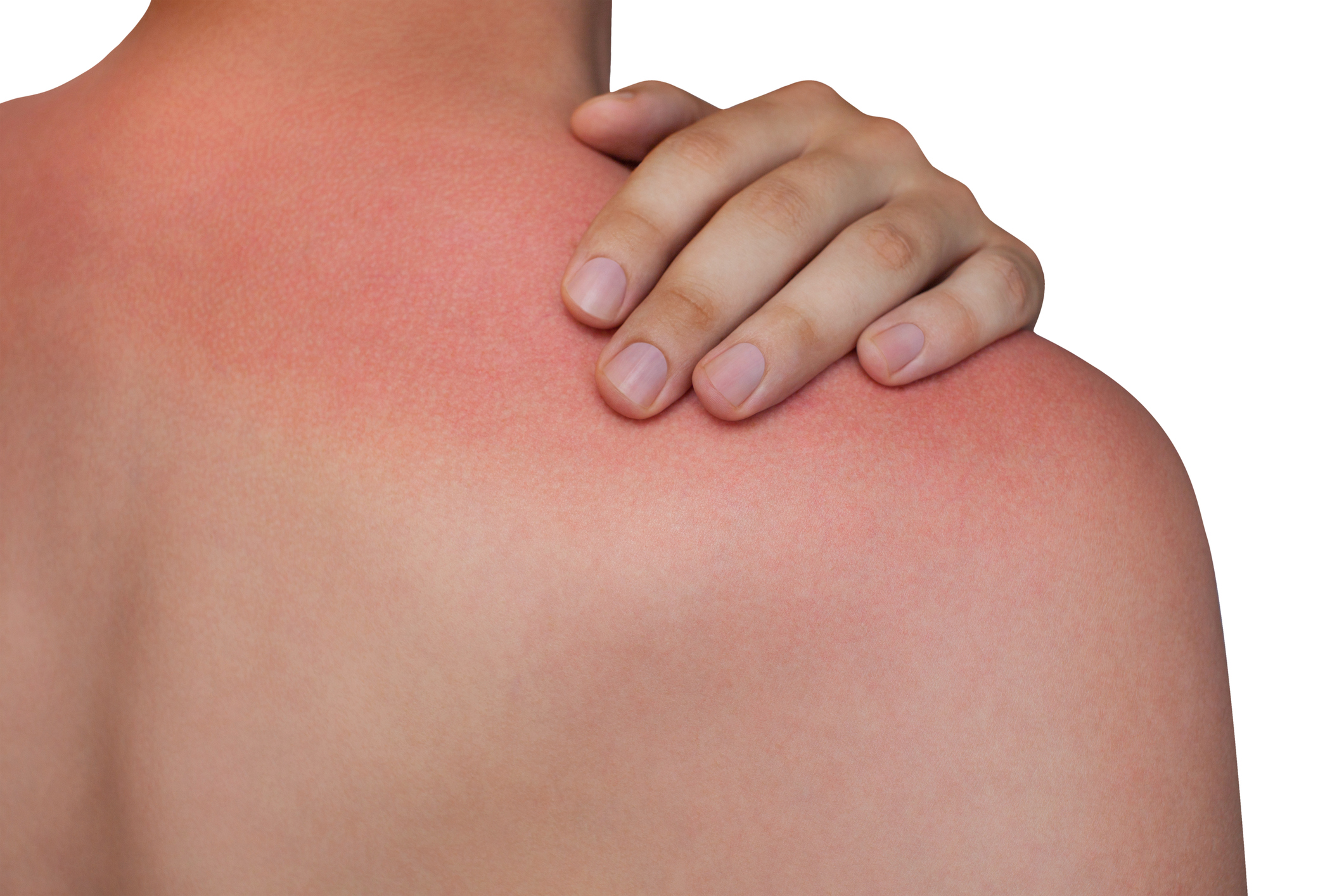 sunburn